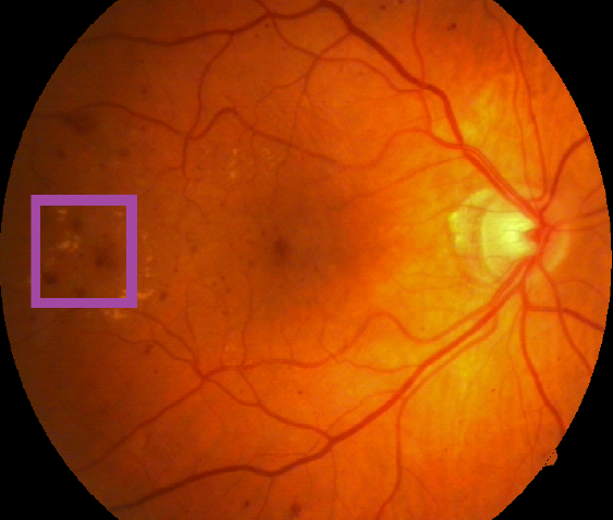 Image of a retina containing a retinal lesion associated with diabetic retinopathy highlighted in purple box