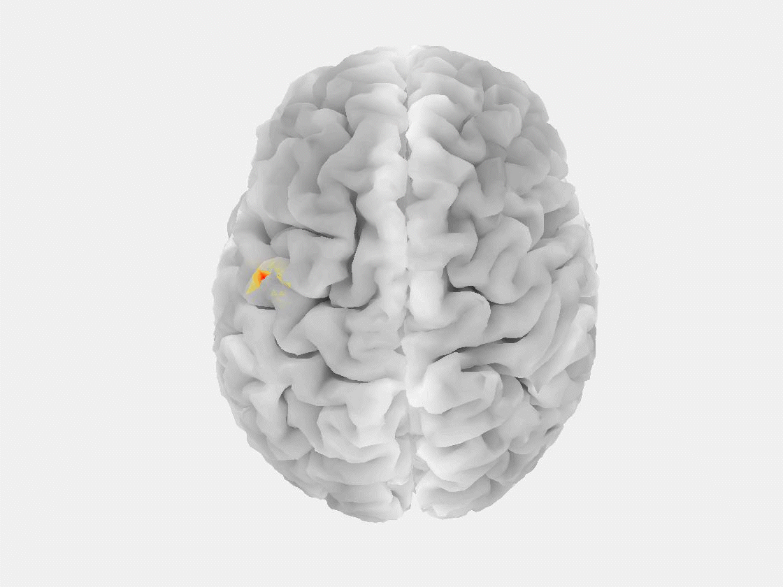 Animation showing the expansion of a brain injury.